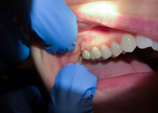 Teeth Whitening in MN